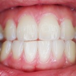 Bone Grafts